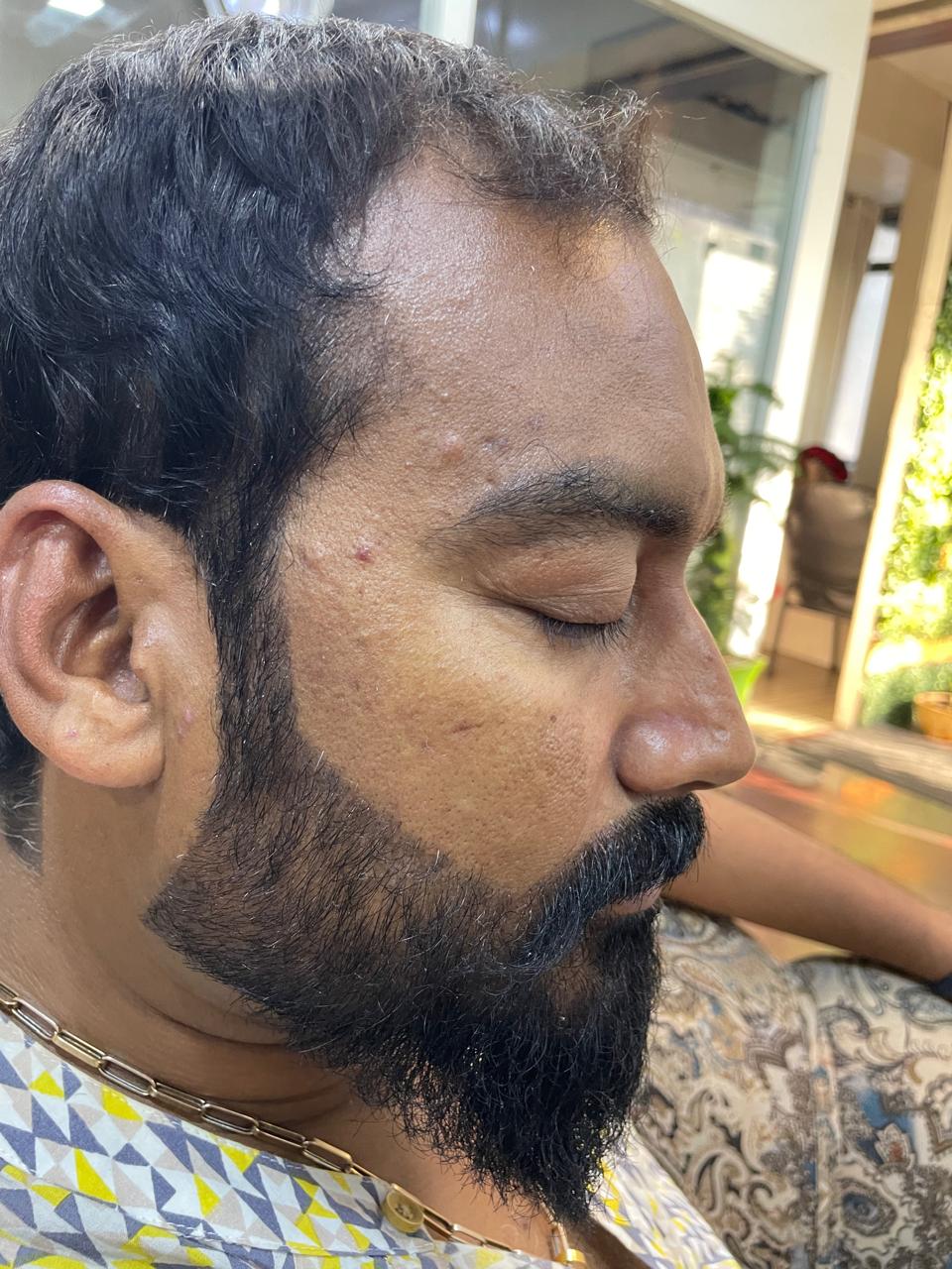 Before - Pigment Laser